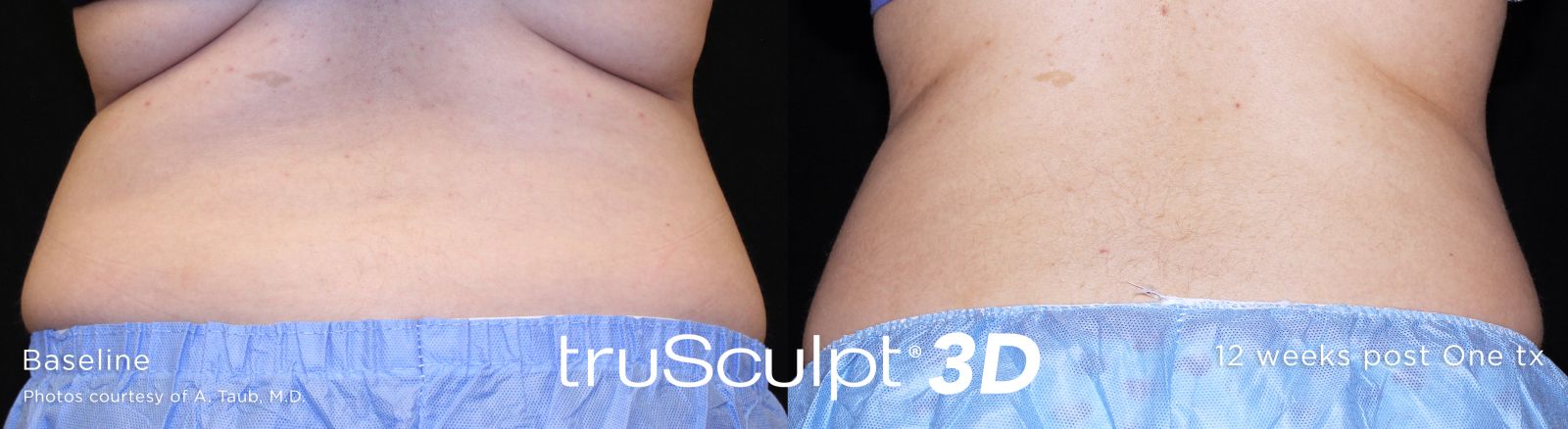 truSculpt 3D 14 3