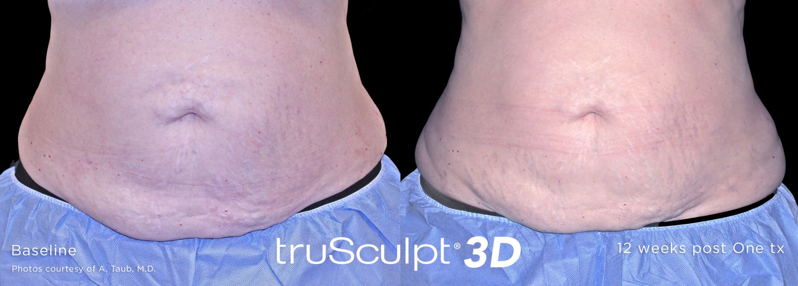 truSculpt 3D 4 1