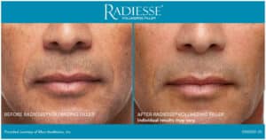 radiesse front smile lines 1 male