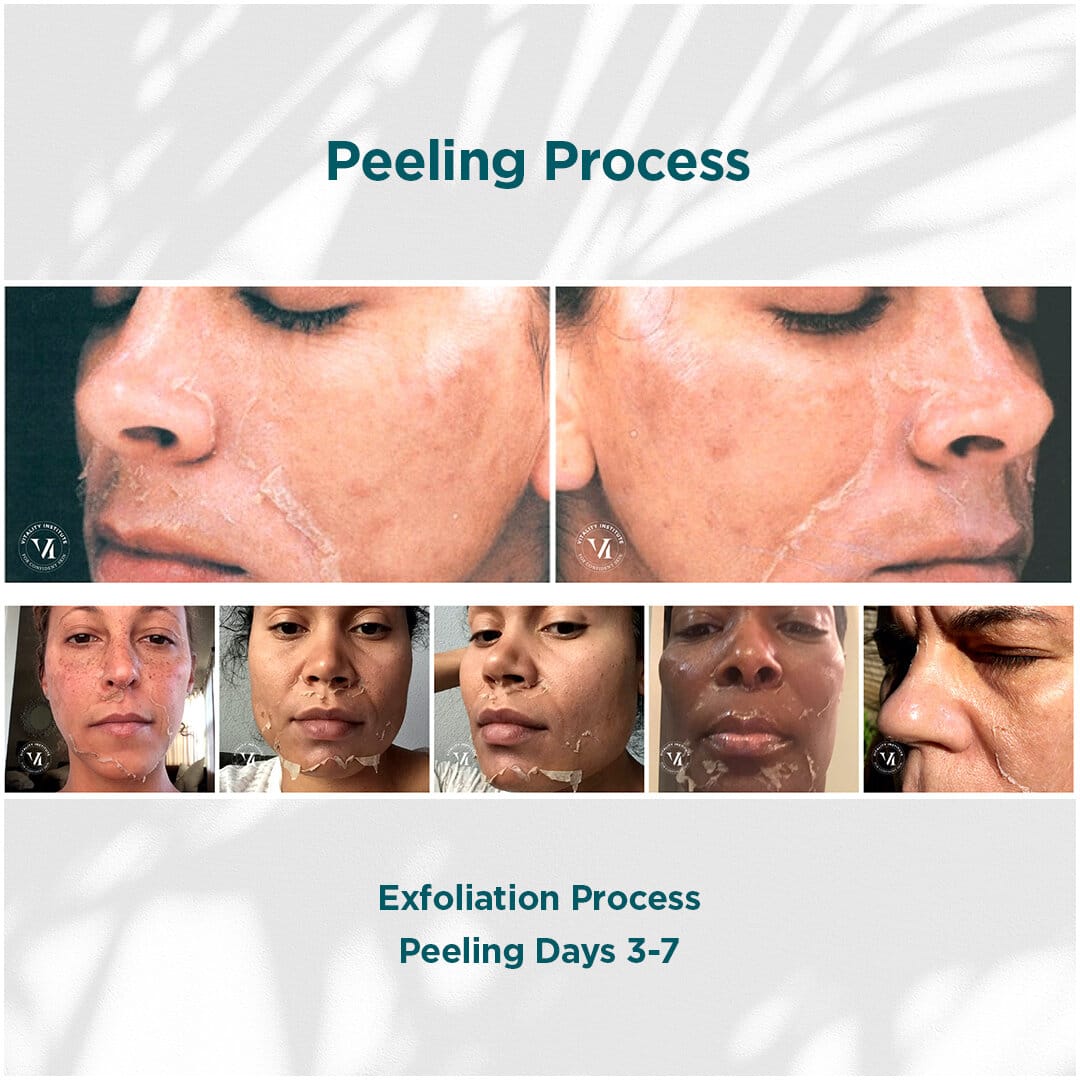 VI Peel B A Peeling Process 1