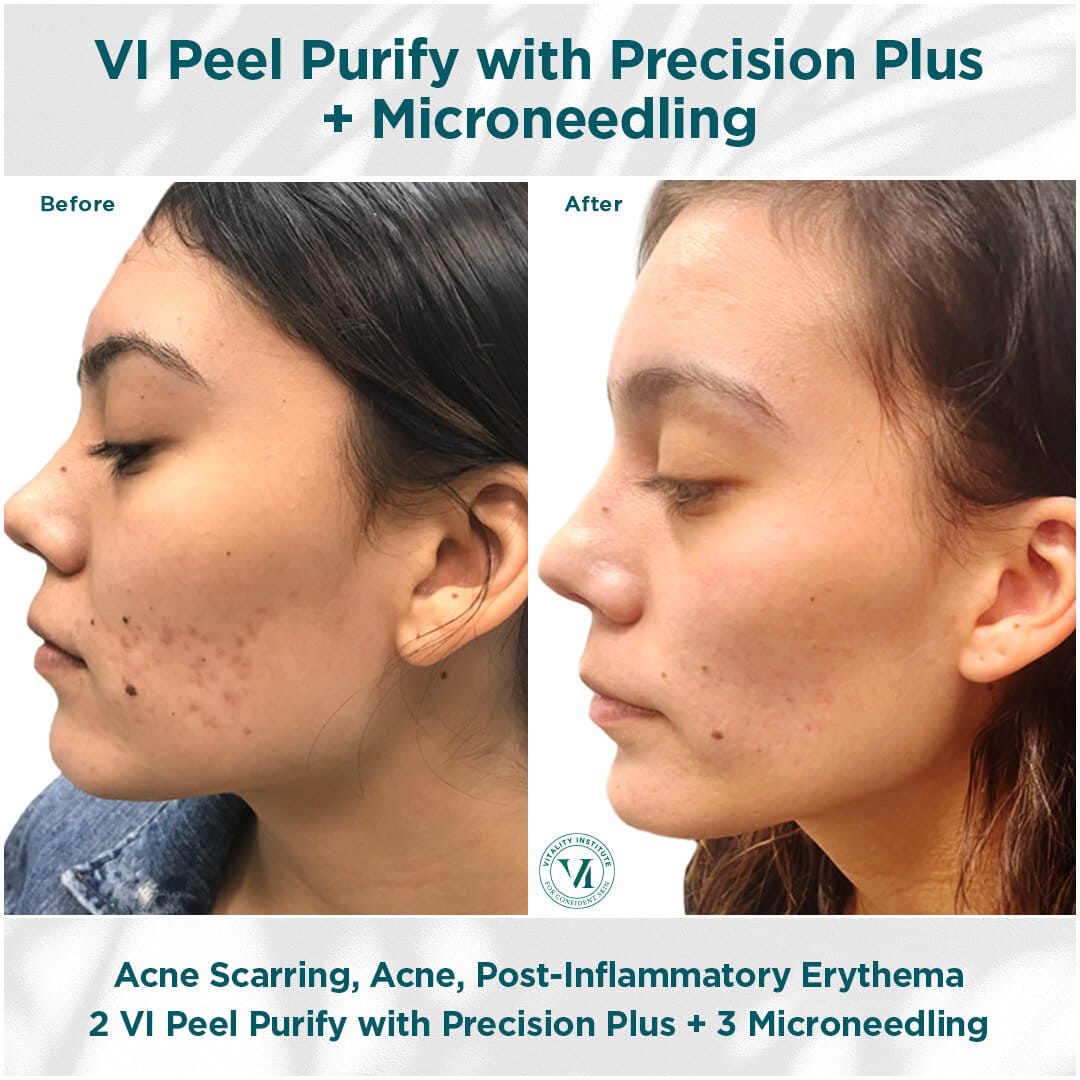 VI Peel B A acne plus microneedling