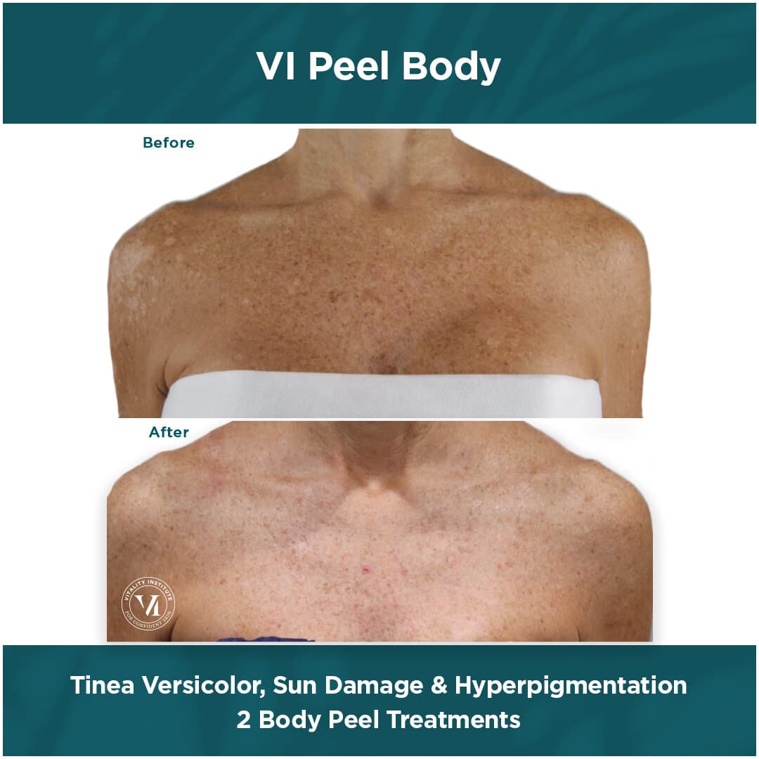 VI Peel B A body tx